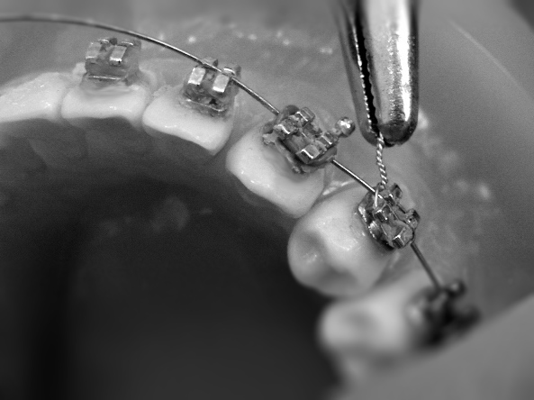 Orthodontics braces